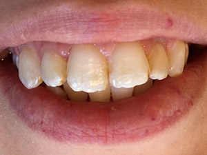 After dental treatment