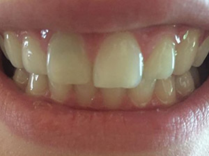 Before dental treatment